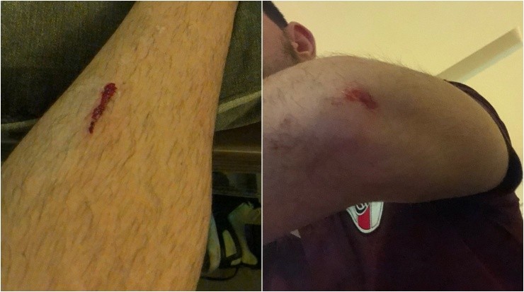 Los raspones que sufrió Gastón en el ingreso al Monumental @gastoniglesiass